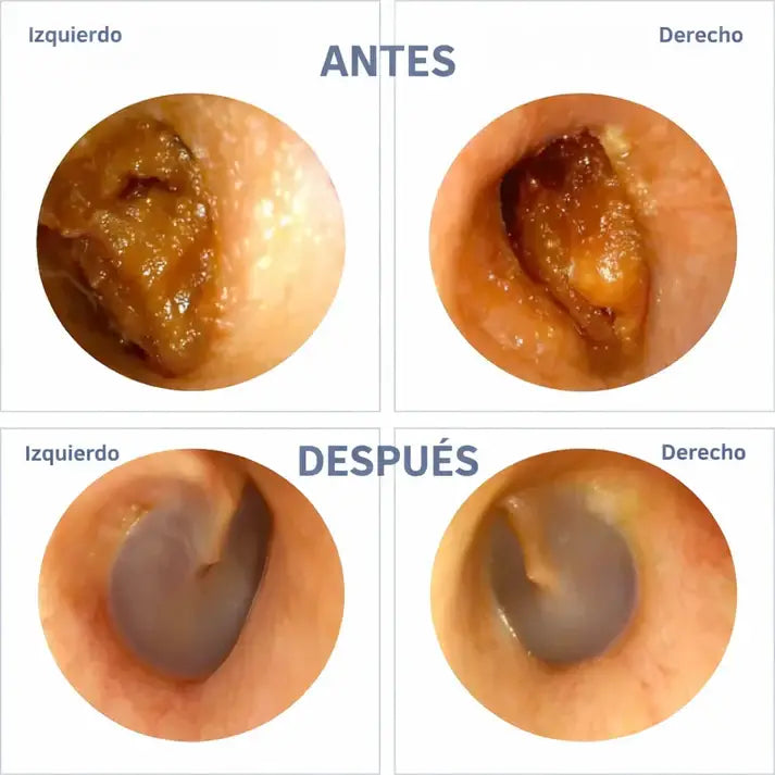 Limpieza de oídos inteligente con tecnología avanzada – WaxClean™